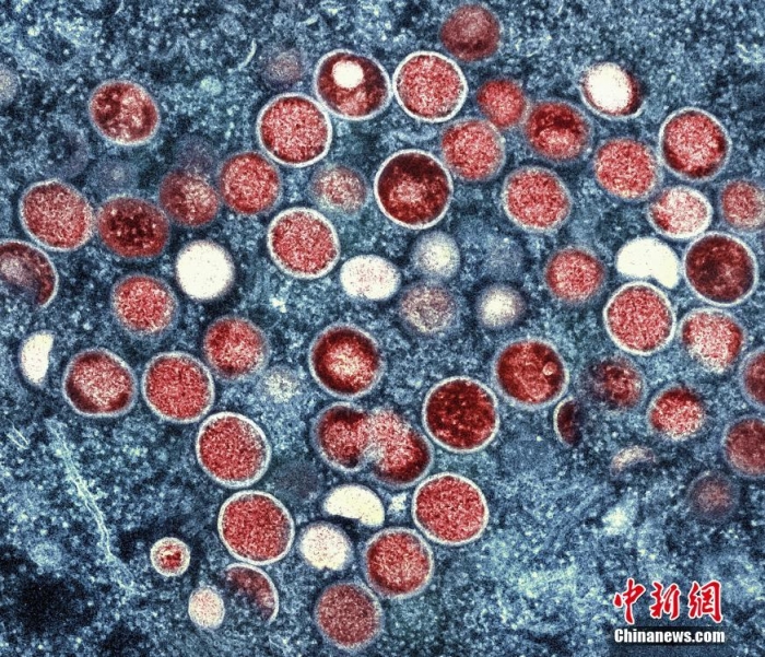 當(dāng)?shù)貢r(shí)間2022年7月26日，美國馬里蘭州，在實(shí)驗(yàn)室培養(yǎng)的感染細(xì)胞(棕色)中發(fā)現(xiàn)的猴痘顆粒(橙色)的彩色透射電子顯微圖。圖片來源：視覺中國