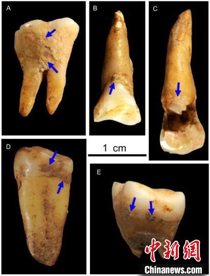 湖南道縣福巖洞8-12萬年前古人類的牙結(jié)石?！清?供圖